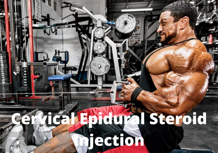 Cervical epidural steroid injection success rates
